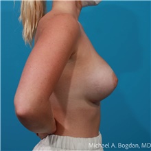 Breast Augmentation After Photo by Michael Bogdan, MD, MBA, FACS; Grapevine, TX - Case 48192