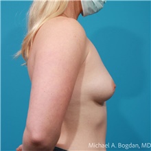 Breast Augmentation Before Photo by Michael Bogdan, MD, MBA, FACS; Grapevine, TX - Case 48192