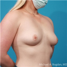 Breast Augmentation Before Photo by Michael Bogdan, MD, MBA, FACS; Grapevine, TX - Case 48192