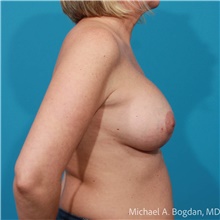 Breast Augmentation After Photo by Michael Bogdan, MD, MBA, FACS; Grapevine, TX - Case 48194