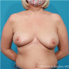 Breast Augmentation Before Photo by Michael Bogdan, MD, MBA, FACS; Grapevine, TX - Case 48194