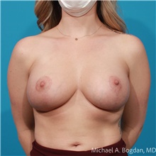 Breast Augmentation After Photo by Michael Bogdan, MD, MBA, FACS; Grapevine, TX - Case 48195