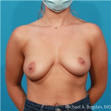 Breast Augmentation Before Photo by Michael Bogdan, MD, MBA, FACS; Grapevine, TX - Case 48195