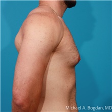 Liposuction Before Photo by Michael Bogdan, MD, MBA, FACS; Grapevine, TX - Case 48196