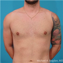 Liposuction After Photo by Michael Bogdan, MD, MBA, FACS; Grapevine, TX - Case 48196