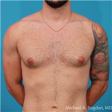 Liposuction Before Photo by Michael Bogdan, MD, MBA, FACS; Grapevine, TX - Case 48196