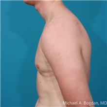 Liposuction After Photo by Michael Bogdan, MD, MBA, FACS; Grapevine, TX - Case 48197
