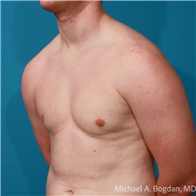 Liposuction After Photo by Michael Bogdan, MD, MBA, FACS; Grapevine, TX - Case 48197