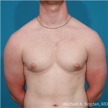 Liposuction Before Photo by Michael Bogdan, MD, MBA, FACS; Grapevine, TX - Case 48197