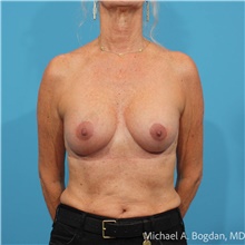 Breast Augmentation After Photo by Michael Bogdan, MD, MBA, FACS; Grapevine, TX - Case 48473