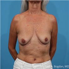Breast Augmentation Before Photo by Michael Bogdan, MD, MBA, FACS; Grapevine, TX - Case 48473