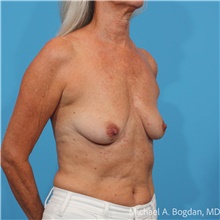 Breast Augmentation Before Photo by Michael Bogdan, MD, MBA, FACS; Grapevine, TX - Case 48473