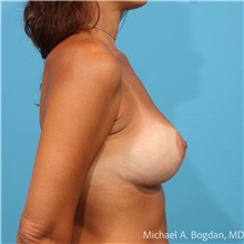 Breast Augmentation After Photo by Michael Bogdan, MD, MBA, FACS; Grapevine, TX - Case 48475