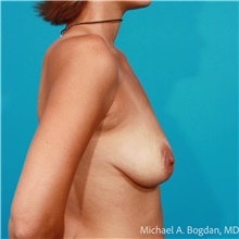 Breast Augmentation Before Photo by Michael Bogdan, MD, MBA, FACS; Grapevine, TX - Case 48475