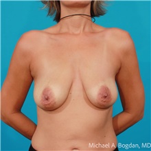 Breast Augmentation Before Photo by Michael Bogdan, MD, MBA, FACS; Grapevine, TX - Case 48475