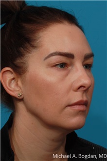 Eyelid Surgery Before Photo by Michael Bogdan, MD, MBA, FACS; Grapevine, TX - Case 48477