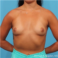 Breast Augmentation Before Photo by Michael Bogdan, MD, MBA, FACS; Grapevine, TX - Case 48767