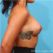 Breast Augmentation After Photo by Michael Bogdan, MD, MBA, FACS; Grapevine, TX - Case 48767