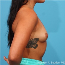 Breast Augmentation Before Photo by Michael Bogdan, MD, MBA, FACS; Grapevine, TX - Case 48767