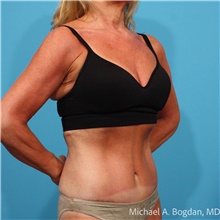 Tummy Tuck After Photo by Michael Bogdan, MD, MBA, FACS; Grapevine, TX - Case 48771