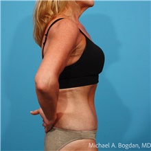 Tummy Tuck After Photo by Michael Bogdan, MD, MBA, FACS; Grapevine, TX - Case 48771