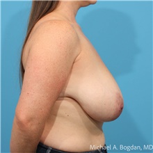 Breast Reduction Before Photo by Michael Bogdan, MD, MBA, FACS; Grapevine, TX - Case 48772