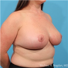 Breast Reduction After Photo by Michael Bogdan, MD, MBA, FACS; Grapevine, TX - Case 48772