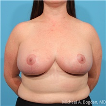 Breast Reduction After Photo by Michael Bogdan, MD, MBA, FACS; Grapevine, TX - Case 48772