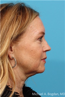 Eyelid Surgery After Photo by Michael Bogdan, MD, MBA, FACS; Grapevine, TX - Case 48775