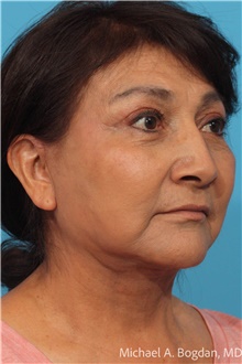 Facelift After Photo by Michael Bogdan, MD, MBA, FACS; Grapevine, TX - Case 48802