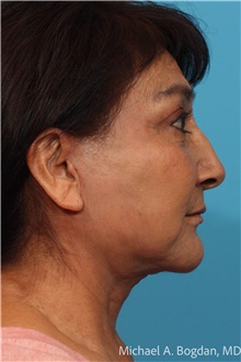 Facelift After Photo by Michael Bogdan, MD, MBA, FACS; Grapevine, TX - Case 48802