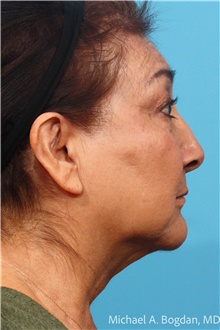 Facelift Before Photo by Michael Bogdan, MD, MBA, FACS; Grapevine, TX - Case 48802