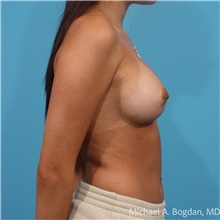 Breast Augmentation After Photo by Michael Bogdan, MD, MBA, FACS; Grapevine, TX - Case 48803