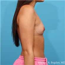 Breast Augmentation Before Photo by Michael Bogdan, MD, MBA, FACS; Grapevine, TX - Case 48803