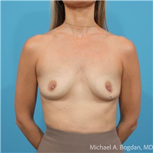 Breast Augmentation Before Photo by Michael Bogdan, MD, MBA, FACS; Grapevine, TX - Case 48804