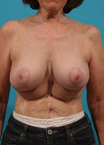 Breast Lift After Photo by Michael Bogdan, MD, MBA, FACS; Grapevine, TX - Case 7772