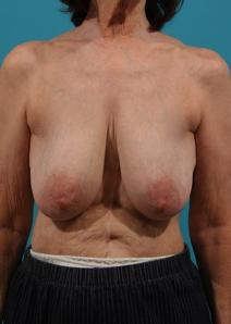 Breast Lift Before Photo by Michael Bogdan, MD, MBA, FACS; Grapevine, TX - Case 7772