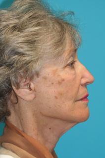 Facelift After Photo by Michael Bogdan, MD, MBA, FACS; Grapevine, TX - Case 7889