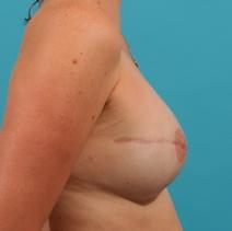 Breast Reconstruction After Photo by Michael Bogdan, MD, MBA, FACS; Grapevine, TX - Case 7898