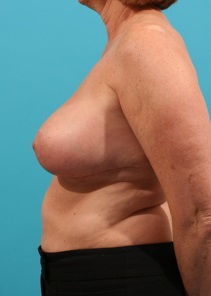 Breast Reduction After Photo by Michael Bogdan, MD, MBA, FACS; Grapevine, TX - Case 8037