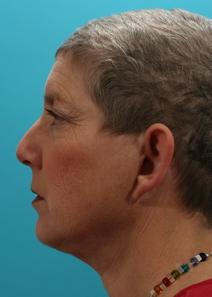 Ear Surgery Before Photo by Michael Bogdan, MD, MBA, FACS; Grapevine, TX - Case 8077