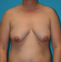Breast Lift Before Photo by Michael Bogdan, MD, MBA, FACS; Grapevine, TX - Case 8163