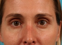 Eyelid Surgery After Photo by Michael Bogdan, MD, MBA, FACS; Grapevine, TX - Case 8207