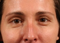 Eyelid Surgery Before Photo by Michael Bogdan, MD, MBA, FACS; Grapevine, TX - Case 8207