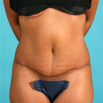 Tummy Tuck After Photo by Michael Bogdan, MD, MBA, FACS; Grapevine, TX - Case 9104