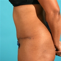 Tummy Tuck After Photo by Michael Bogdan, MD, MBA, FACS; Grapevine, TX - Case 9104