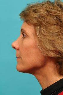 Facelift After Photo by Michael Bogdan, MD, MBA, FACS; Grapevine, TX - Case 9884
