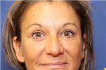 Brow Lift After Photo by Richard Beil, MD; Ann Arbor, MI - Case 31440