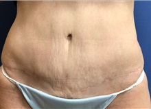 Liposuction After Photo by Richard Beil, MD; Saline, MI - Case 35547