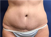 Liposuction Before Photo by Richard Beil, MD; Saline, MI - Case 35547